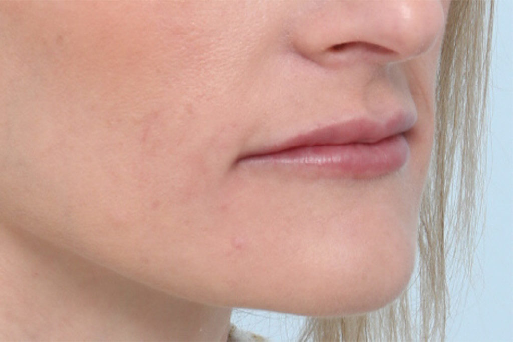 Oblique view after lip augmentation at Mirror Mirror Beauty Boutique | Houston, TX.