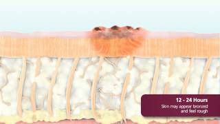 What is the Fraxel Laser