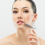 Treat Acne Scars With This Special Non-Surgical Solution