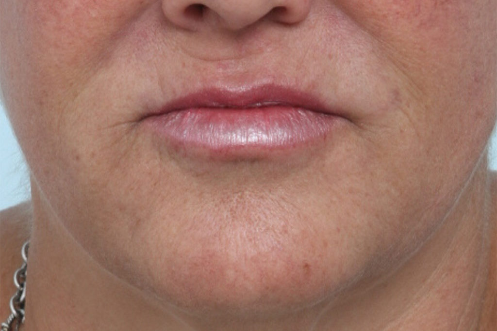Front view after lip augmentation at Mirror Mirror Beauty Boutique | Houston, TX.