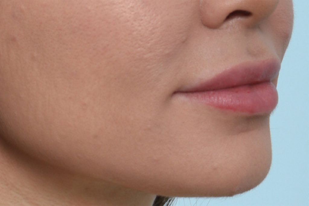 Oblique view after lip augmentation at Mirror Mirror Beauty Boutique | Houston, TX.