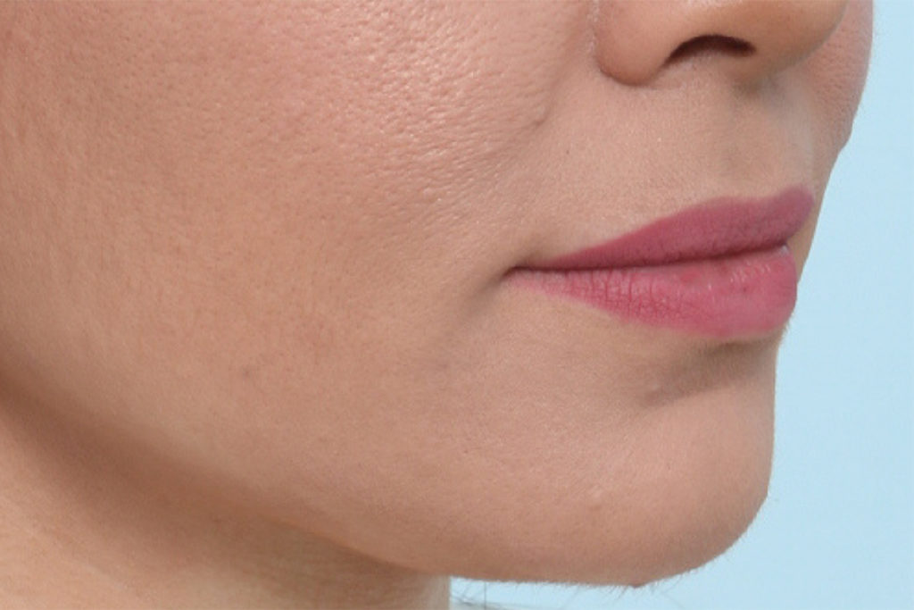 Oblique view before lip augmentation at Mirror Mirror Beauty Boutique | Houston, TX.