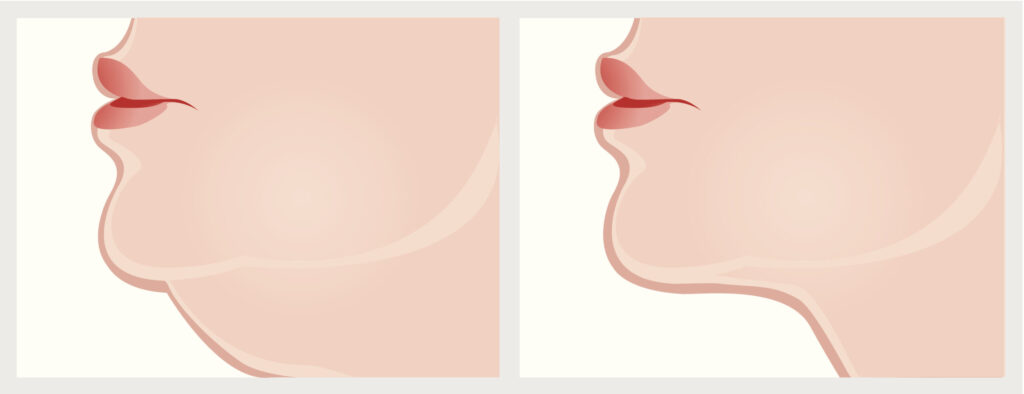 Neck before and after treatment.