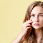 Common Acne Myths
