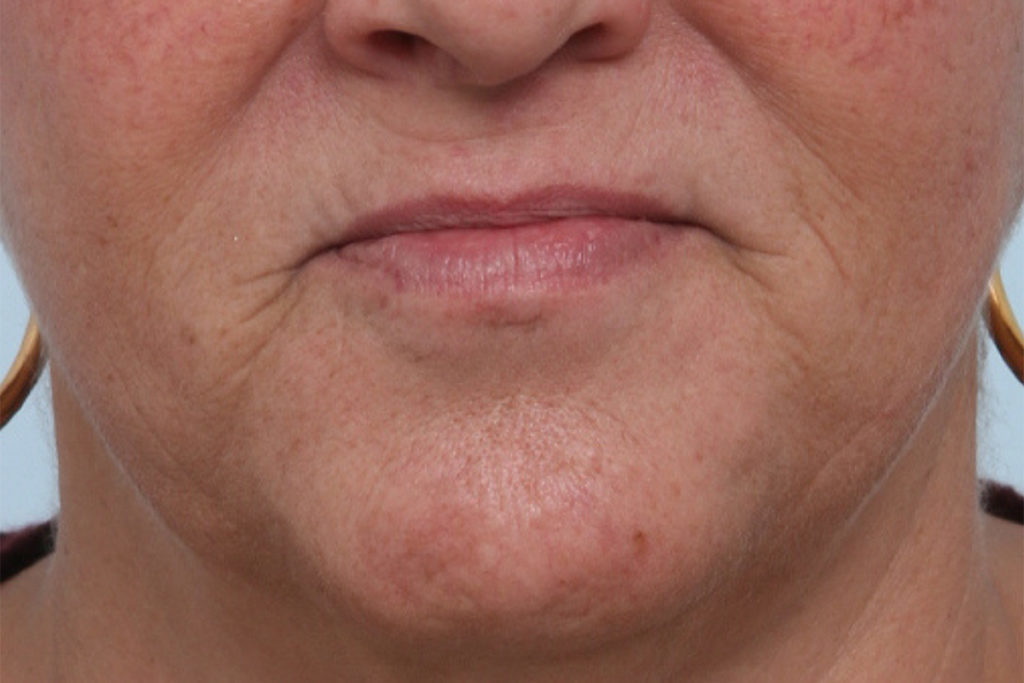 Front view before lip augmentation at Mirror Mirror Beauty Boutique | Houston, TX.