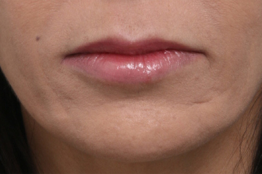Front view after lip augmentation at Mirror Mirror Beauty Boutique | Houston, TX.
