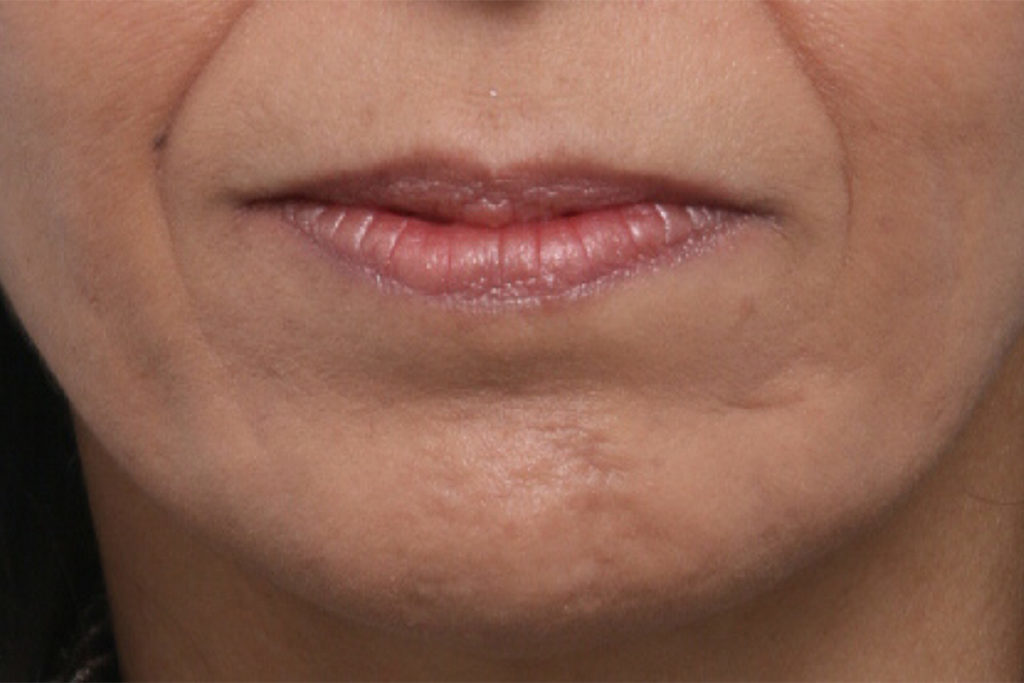 Front view before lip augmentation at Mirror Mirror Beauty Boutique | Houston, TX.

