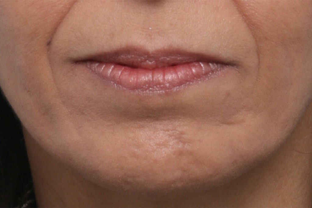 Front view before lip augmentation at Mirror Mirror Beauty Boutique | Houston, TX.