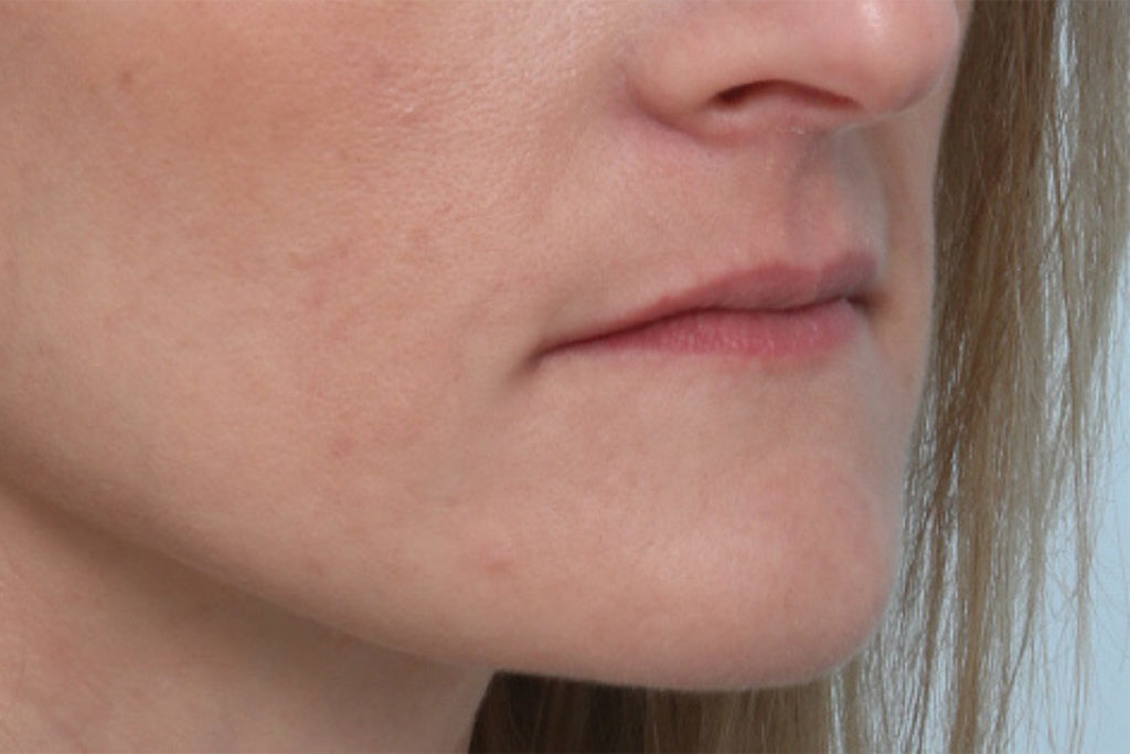 Oblique view before lip augmentation at Mirror Mirror Beauty Boutique | Houston, TX.

