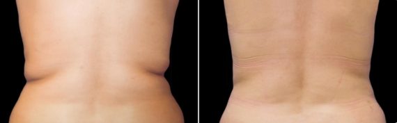 CoolSculpting Before and After Photos in Houston, TX, Patient 7803