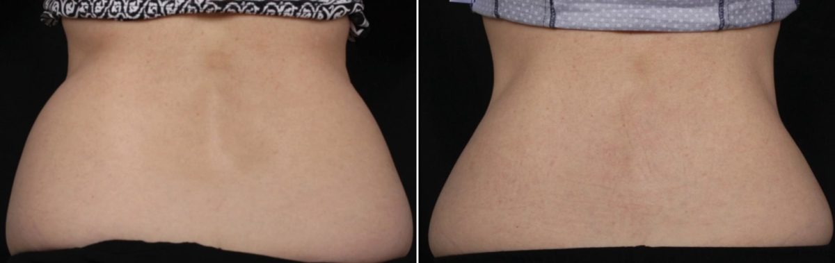 CoolSculpting Before and After Photos in Houston, TX, Patient 7811