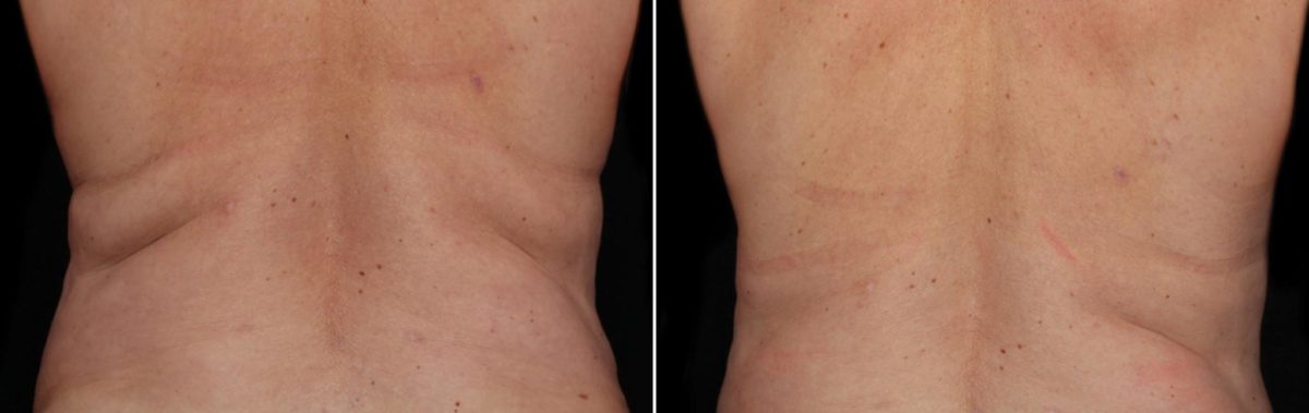 CoolSculpting Before and After Photos in Houston, TX, Patient 7814