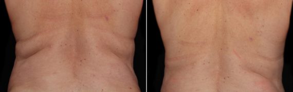 CoolSculpting Before and After Photos in Houston, TX, Patient 7814