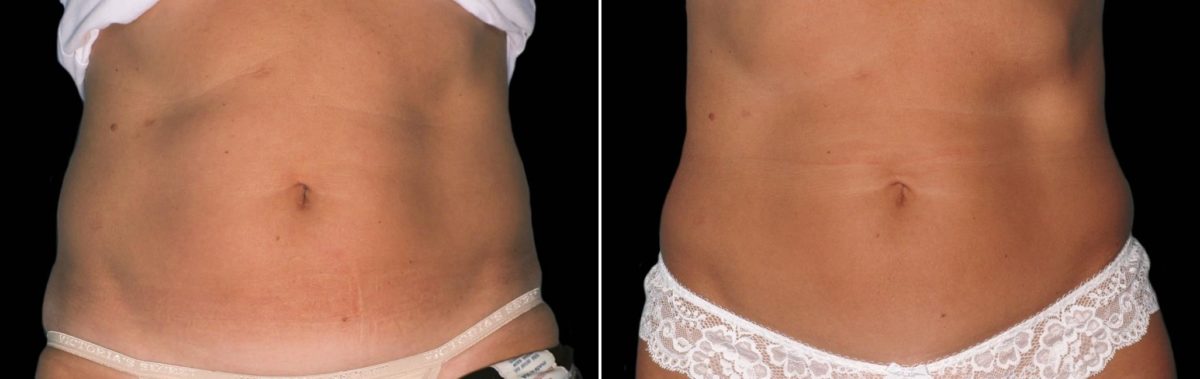 CoolSculpting Before and After Photos in Houston, TX, Patient 7785