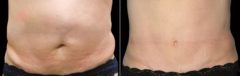 CoolSculpting Before and After Photos in Houston, TX, Patient 7780