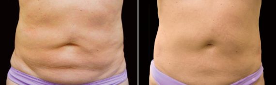 CoolSculpting Before and After Photos in Houston, TX, Patient 7790