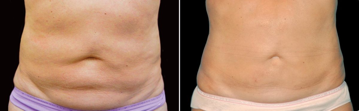CoolSculpting Before and After Photos in Houston, TX, Patient 7790