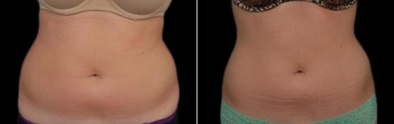 CoolSculpting Before and After Photos in Houston, TX, Patient 7795