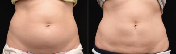 CoolSculpting Before and After Photos in Houston, TX, Patient 7798