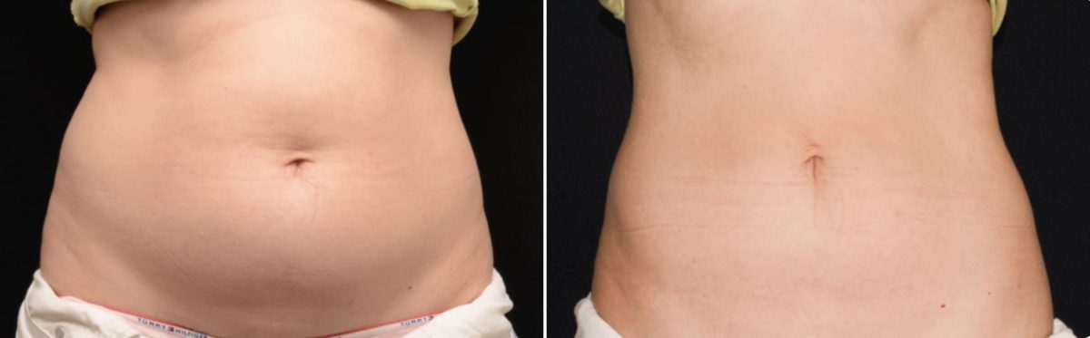 CoolSculpting Before and After Photos in Houston, TX, Patient 7798