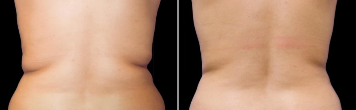 CoolSculpting Before and After Photos in Houston, TX, Patient 7803