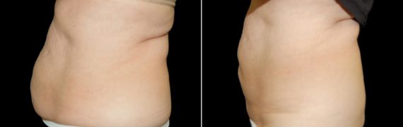 CoolSculpting Before and After Photos in Houston, TX, Patient 7825