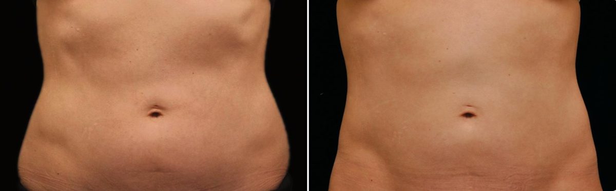 CoolSculpting Before and After Photos in Houston, TX, Patient 7848