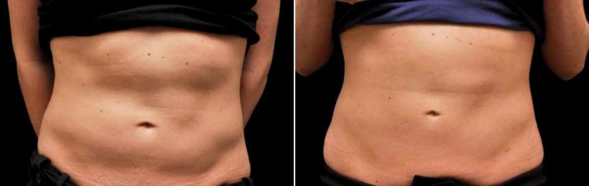 CoolSculpting Before and After Photos in Houston, TX, Patient 7853