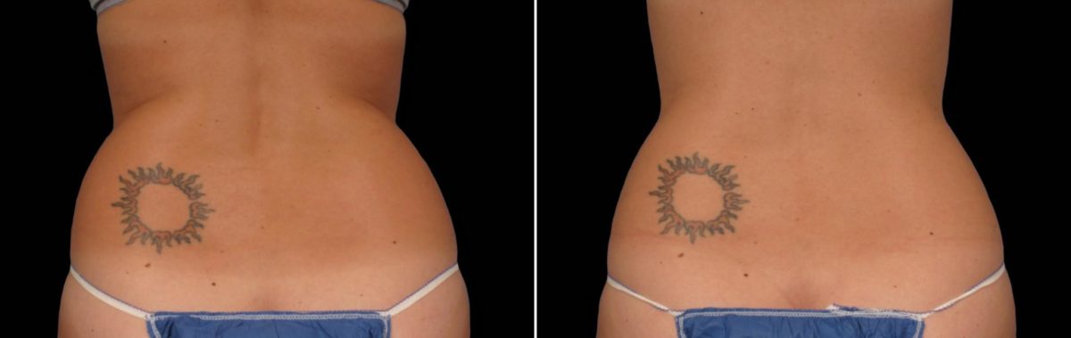 CoolSculpting Before and After Photos in Houston, TX, Patient 7828