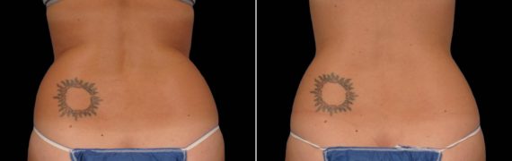CoolSculpting Before and After Photos in Houston, TX, Patient 7828