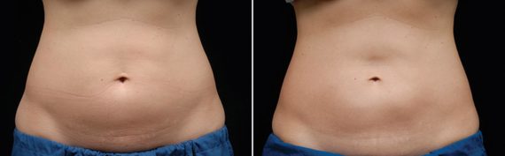 CoolSculpting Before and After Photos in Houston, TX, Patient 7831