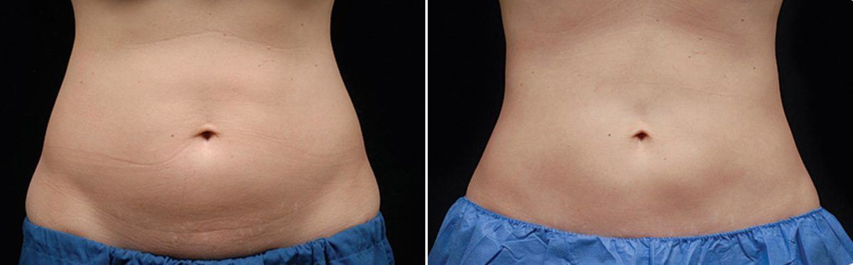 CoolSculpting Before and After Photos in Houston, TX, Patient 7831