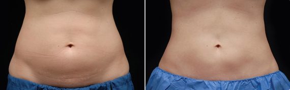 CoolSculpting Before and After Photos in Houston, TX, Patient 7831