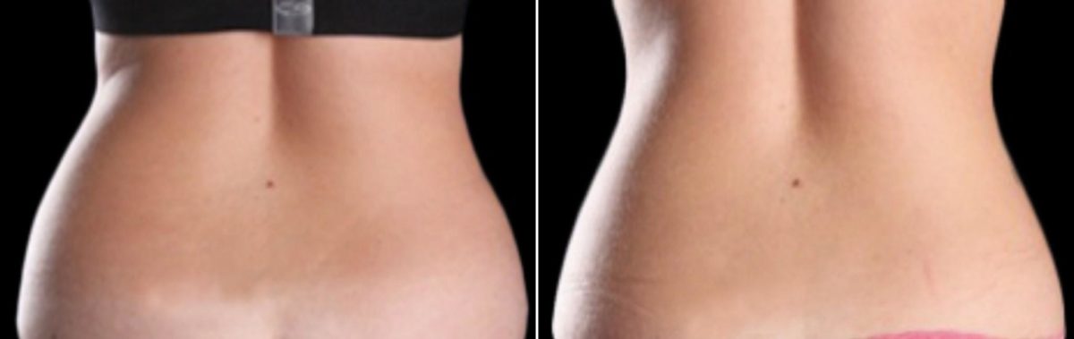 CoolSculpting Before and After Photos in Houston, TX, Patient 7836