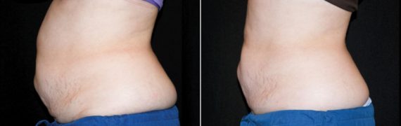 CoolSculpting Before and After Photos in Houston, TX, Patient 7839