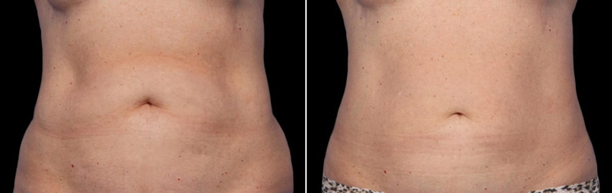 CoolSculpting Before and After Photos in Houston, TX, Patient 7842