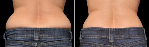 CoolSculpting Before and After Photos in Houston, TX, Patient 7845