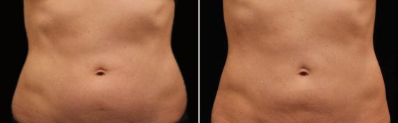 CoolSculpting Before and After Photos in Houston, TX, Patient 7848