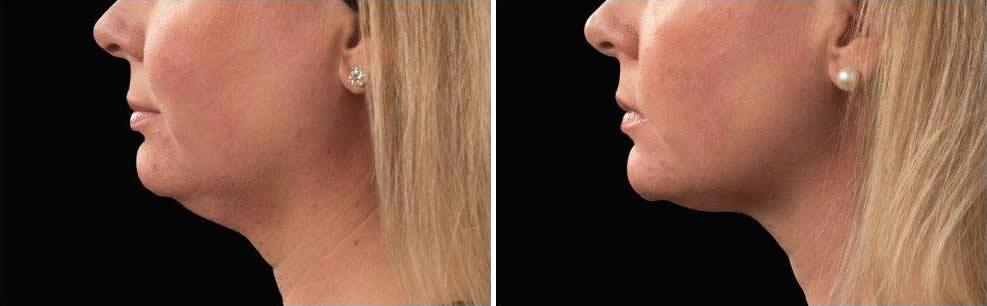 Side View Before & After Patient Photos | Neck Rejuvenation Houston, TX | Mirror Mirror Beauty Boutique