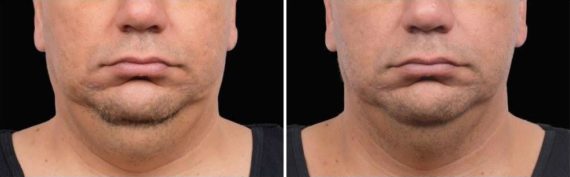 CoolSculpting Before and After Photos in Houston, TX, Patient 7875