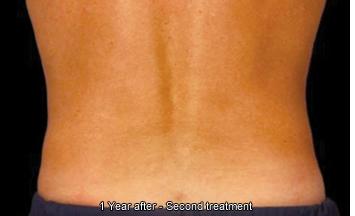 CoolSculpting Before and After Photos in Houston, TX, Patient 7862