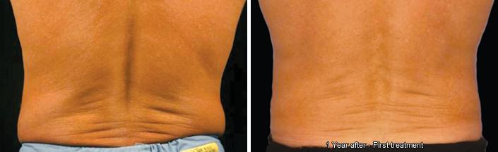 CoolSculpting Before and After Photos in Houston, TX, Patient 7862