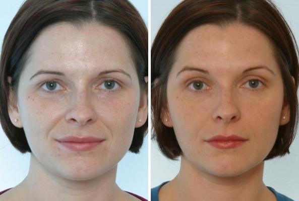 Fillers - Patient 1 - Before & After