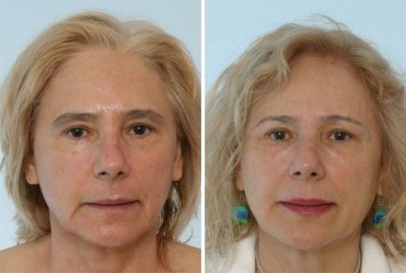 Fillers Before and After Photos in Houston, TX