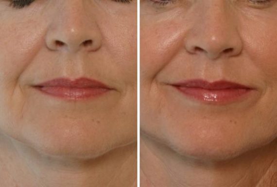 Fillers Before and After Photos in Houston, TX, Patient 7892