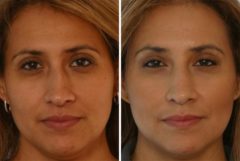 Fillers Before and After Photos in Houston, TX, Patient 7898