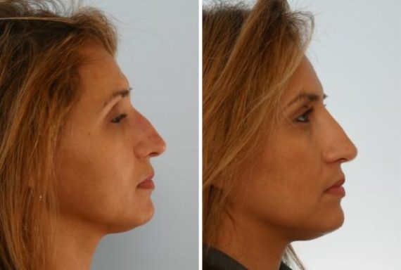 Fillers Before and After Photos in Houston, TX, Patient 7898