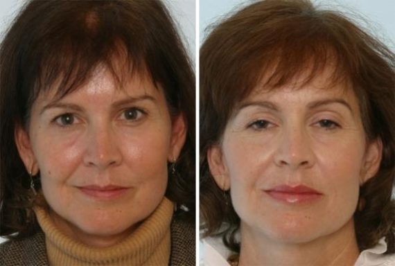 Fillers Before and After Photos in Houston, TX, Patient 7915