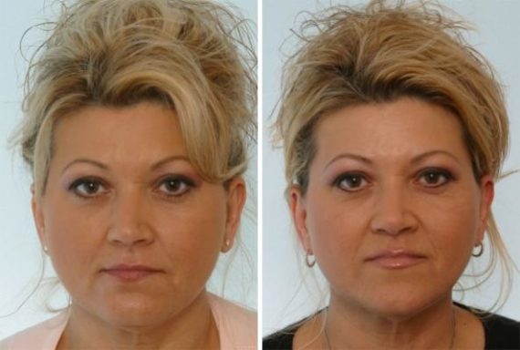 Fillers Before and After Photos in Houston, TX, Patient 7912