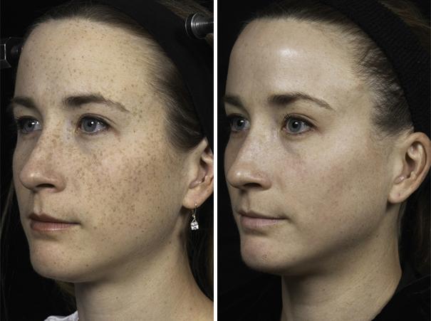 Fraxel Laser - Patient 1 - Before & After